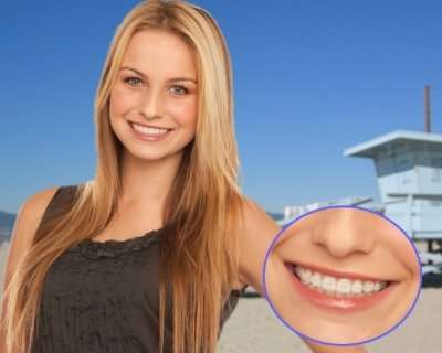 Types Of Braces, Braces Treatment In Beverly Hills